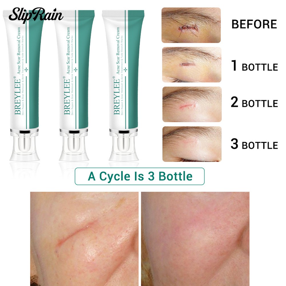 breylee scar removal cream
