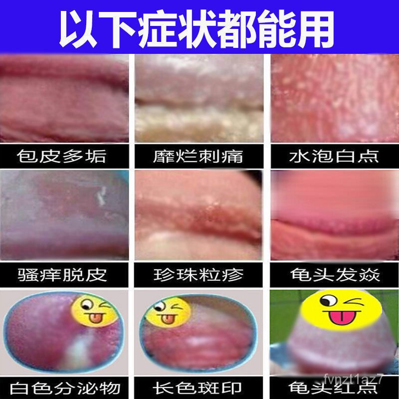 龟头炎包皮炎龟头红肿瘙痒异味溃疡糜烂潮湿一碰就疼杀菌止痒 Shopee Singapore
