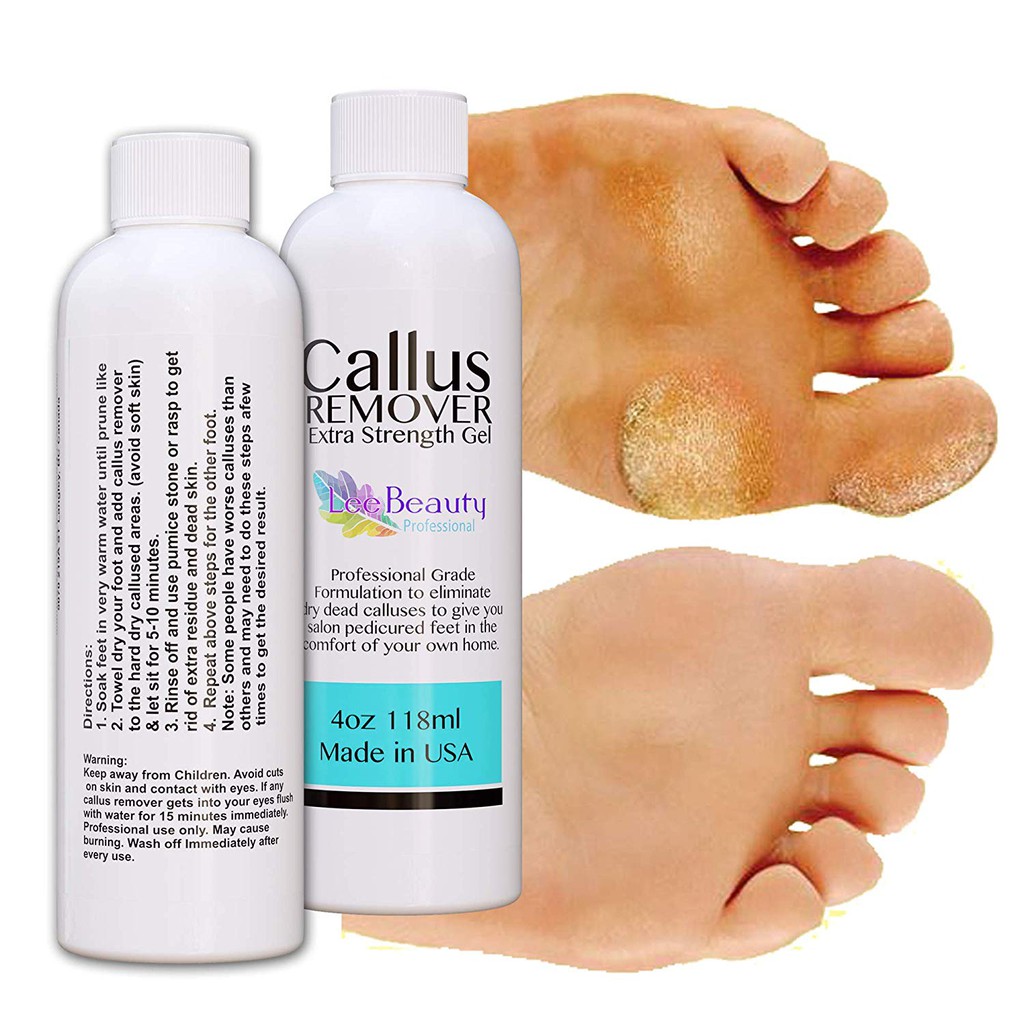 Callus remover