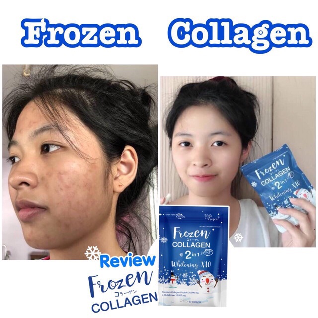 Shop Malaysia Combo Set Gluta Frozen Frozen Collagen Whitening Skin Beauty Supplement Shopee Singapore