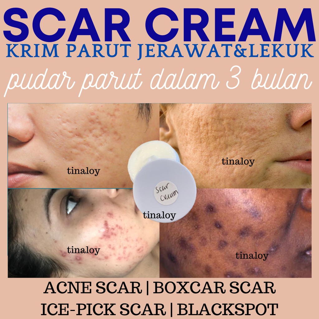 Shop Malaysia Scar Cream Primer Parut Lekuk Holed Scar Ex Acne Treatment Jerawat Skin Care Anti Bacterial Scar Dark Spot Refine Shopee Singapore