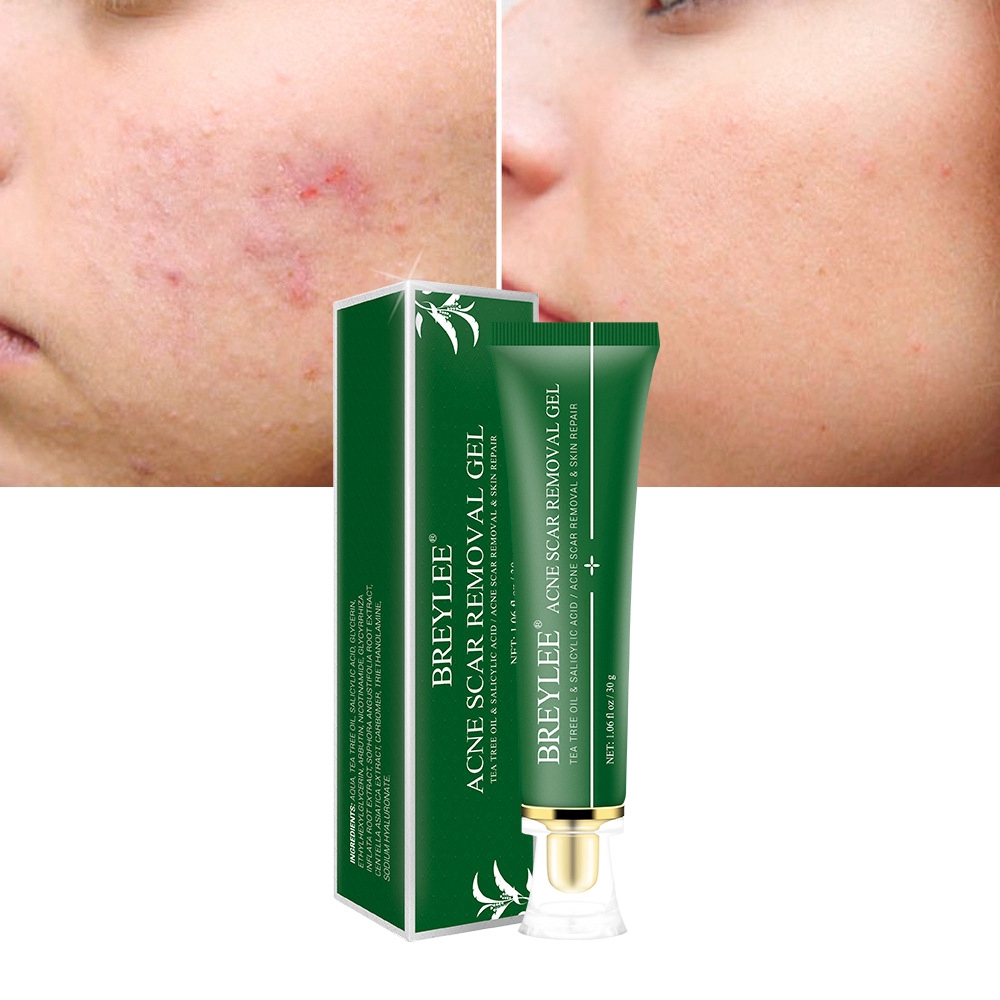 serum to prevent acne