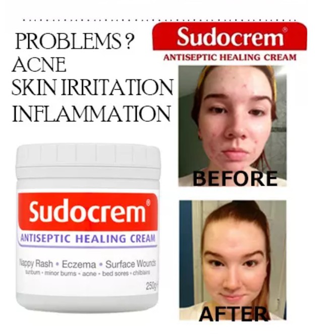sudocrem spot cream