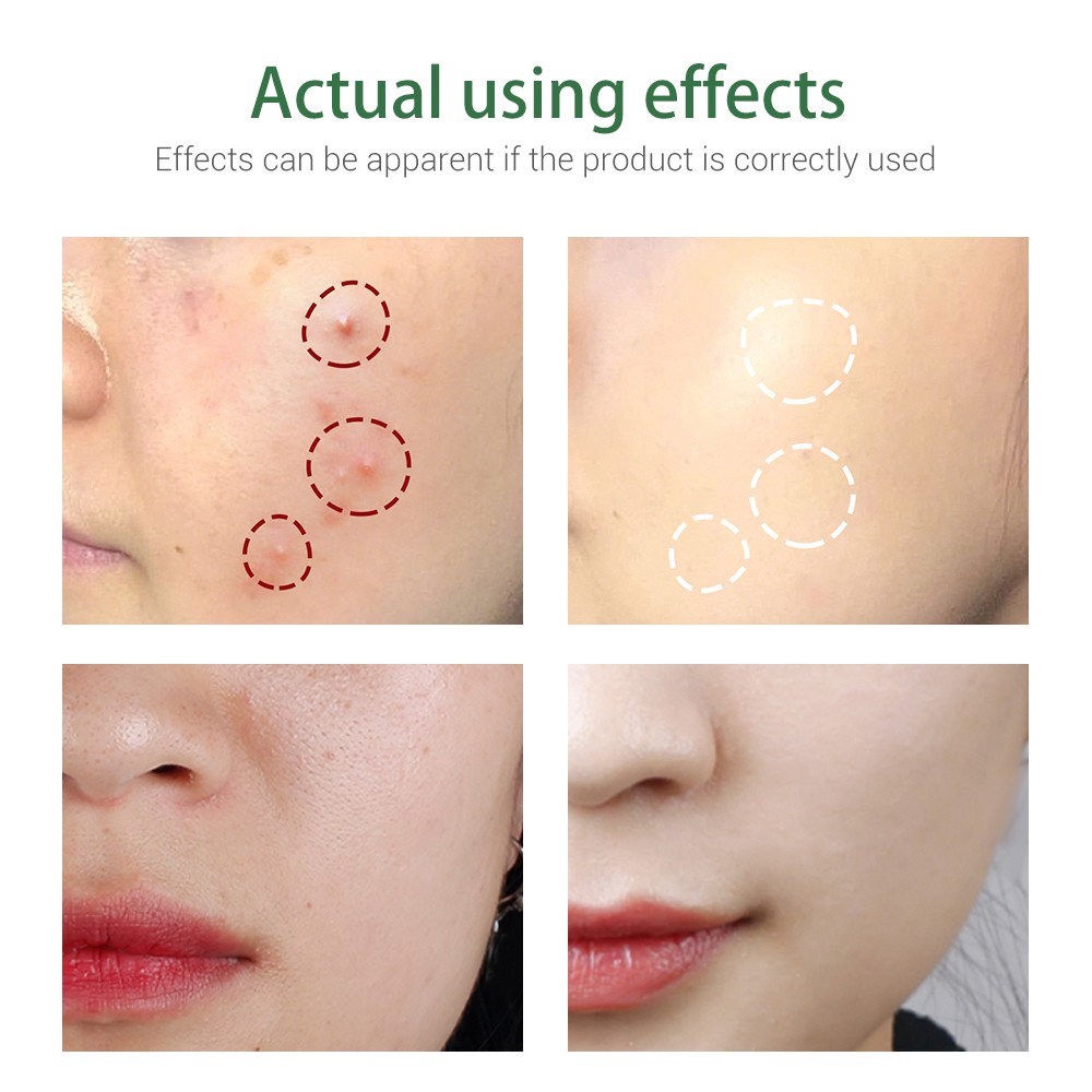 breylee acne treatment facial cleanser