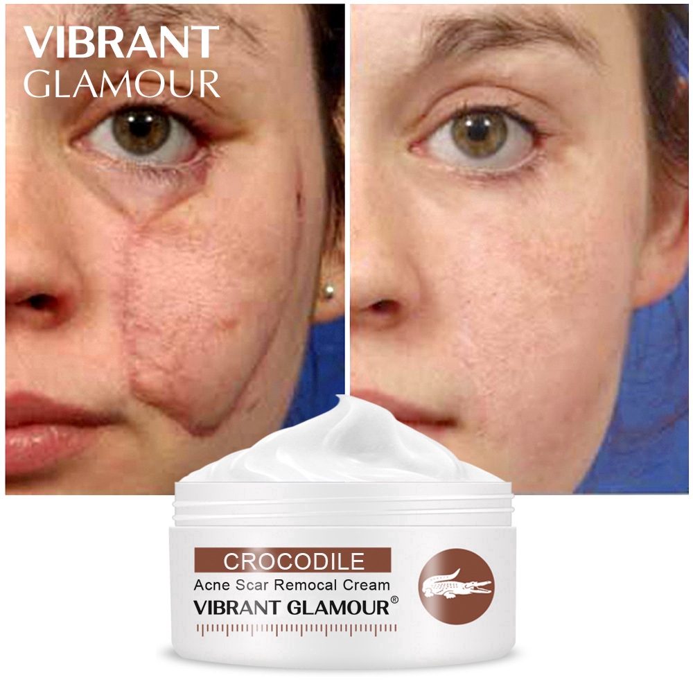 acne scar removal moisturizer