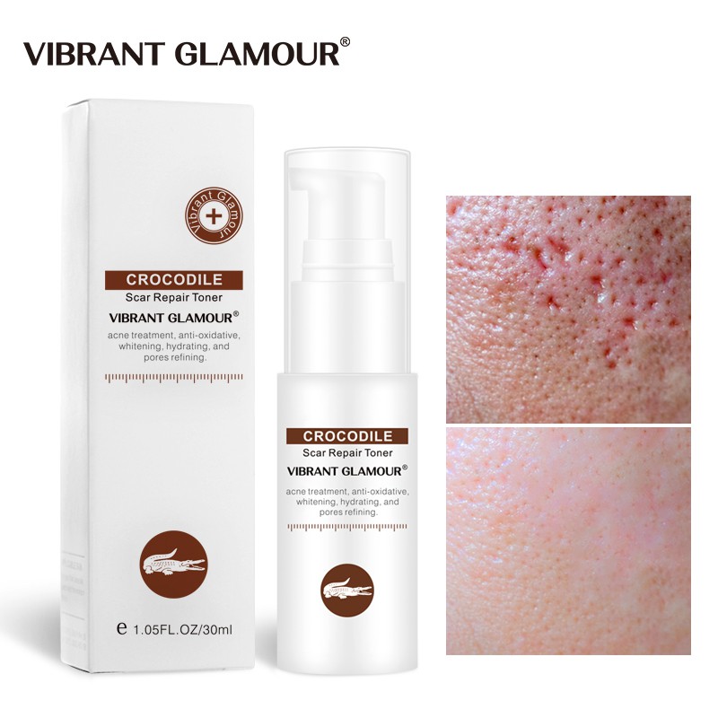 acne removal for sensitive skin