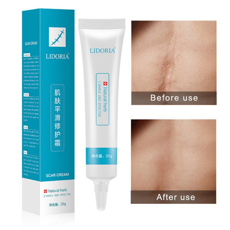 lidoria acne cream