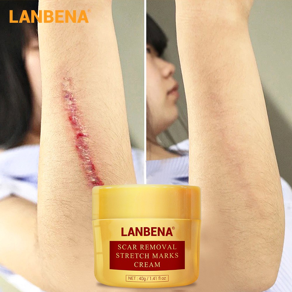 lanbena-scar-removal-cream-acne-treatment-repairing-scar-shopee-singapore