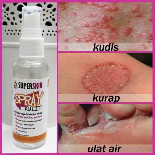 Shop Malaysia Ubat Kurap Itching Rich Of Eczema Rash Eczema Kudis Psoriasis Scabies Itchy Ringworm Eating Water Quality Buta Shopee Singapore