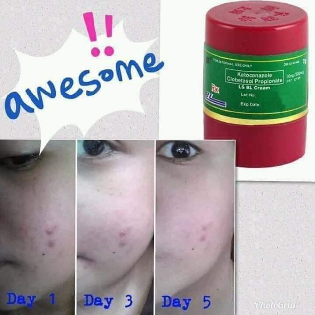 bl cream for acne scars