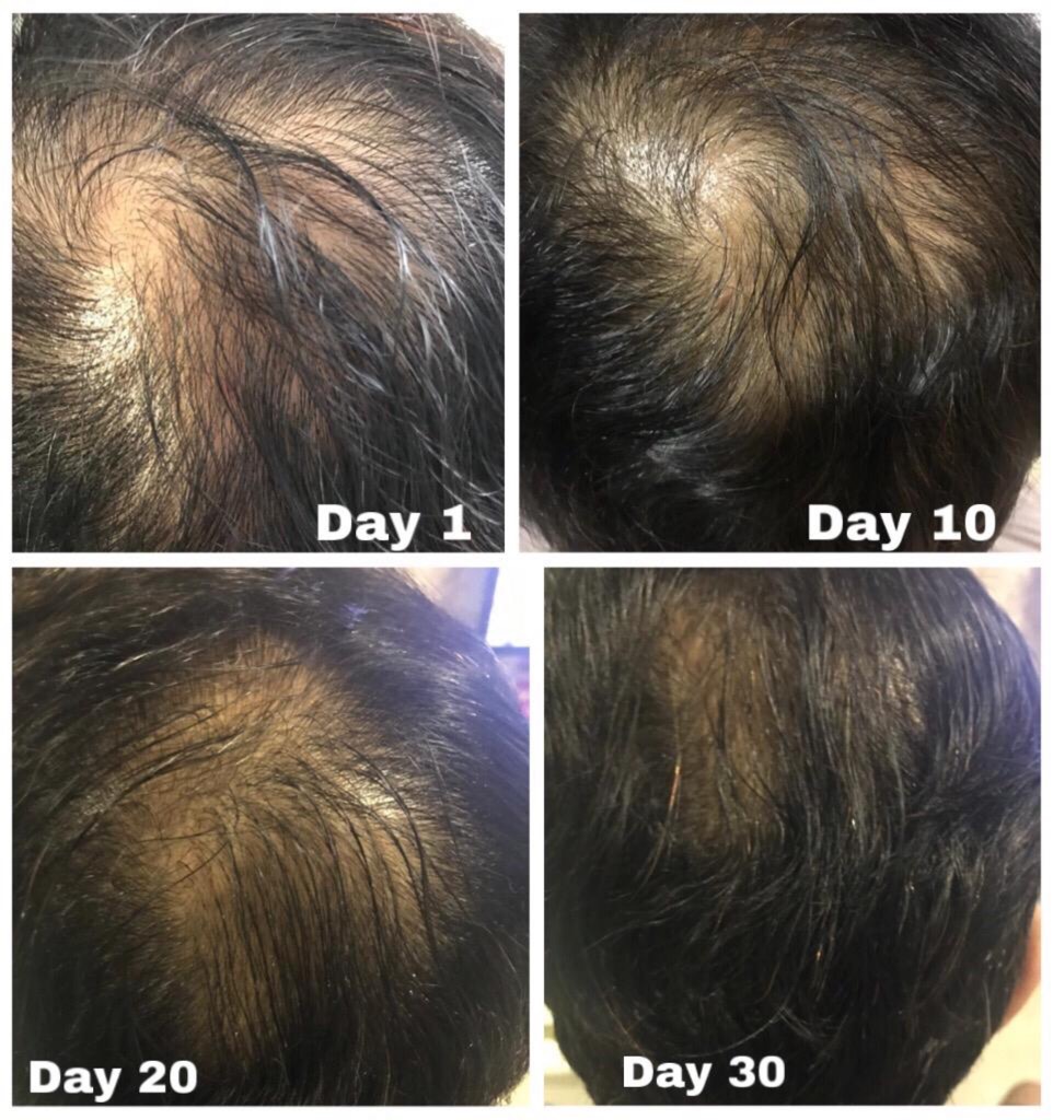 Psoriasis Scalp Anti Dandruff Hair Loss Shampoo Conditioner