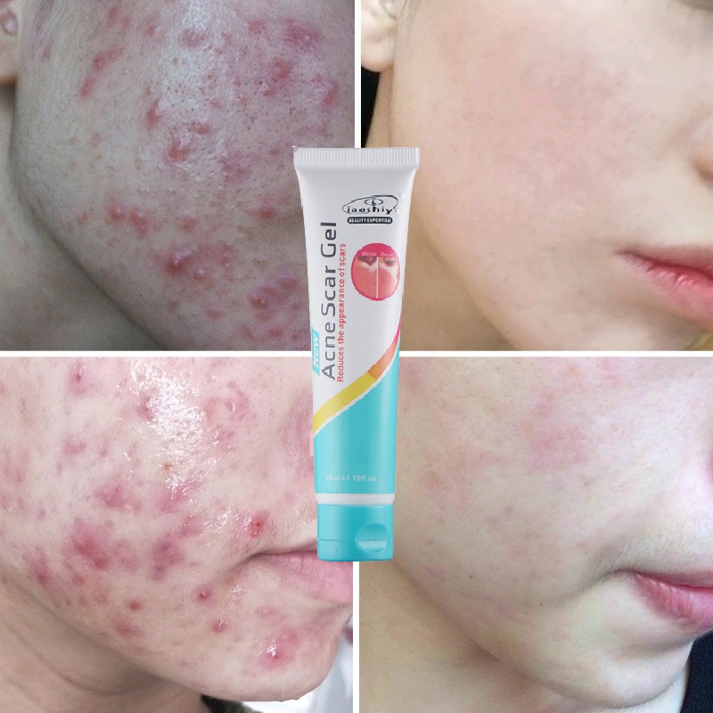 Gel Giảm Mụn, Mờ Sẹo Thâm Do Mụn, Sẹo Do Phẫu Thuật Laoshiya Acne scar gel