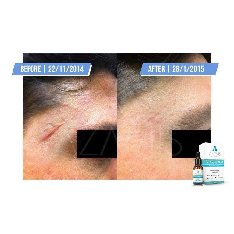 Azanis Scar Serum Enhanced With Vitamin E New Improved Formula Removes All Scars Fast 15ml Shopee Singapore