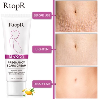 RtopR Mango Remove Pregnancy Scars Acne Cream Stretch Marks Treatment Maternity Repair Anti-Aging Anti-Winkles Firming Body Creams #4
