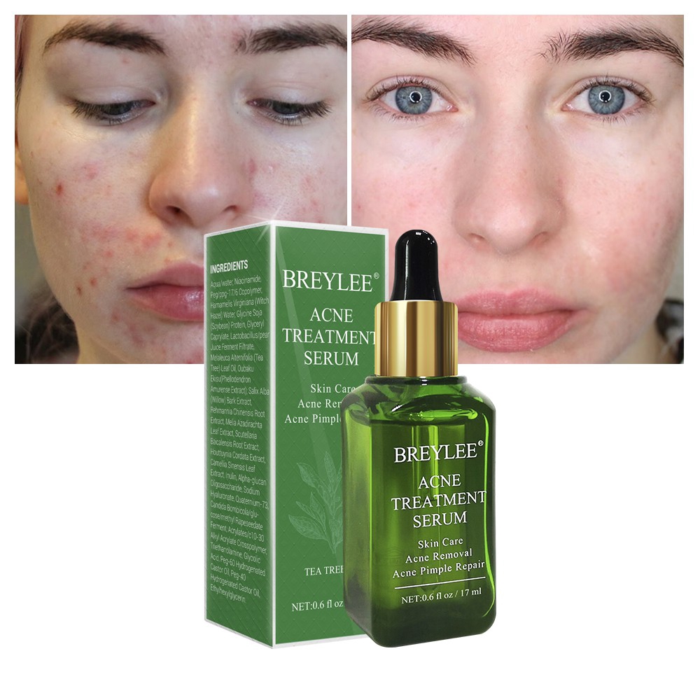 serum for acne and acne scars
