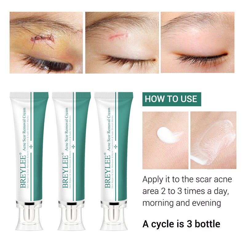 breylee acne scar removal cream