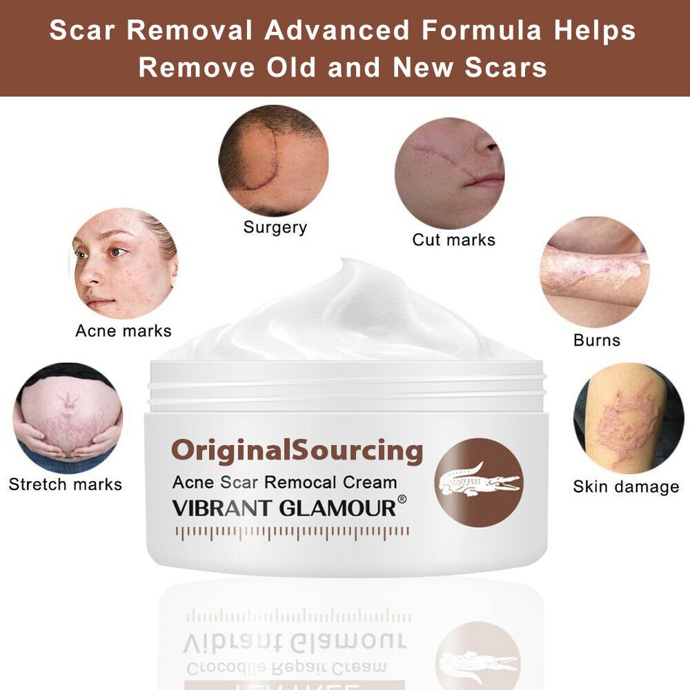 skin stretch marks removal cream