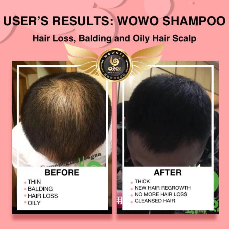 Wowo Hair Care Anti Hair Loss Anti Dandruff For Dry Oily