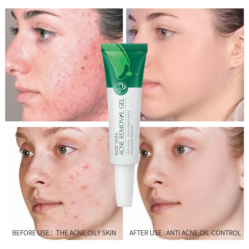 aloe vera gel use for oily skin