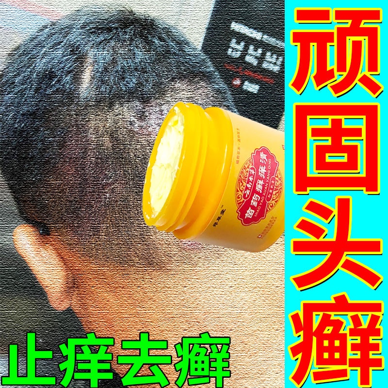 Plaster / ointment/♤[Special for tinea capitis] Scalp, ringworm, scalp