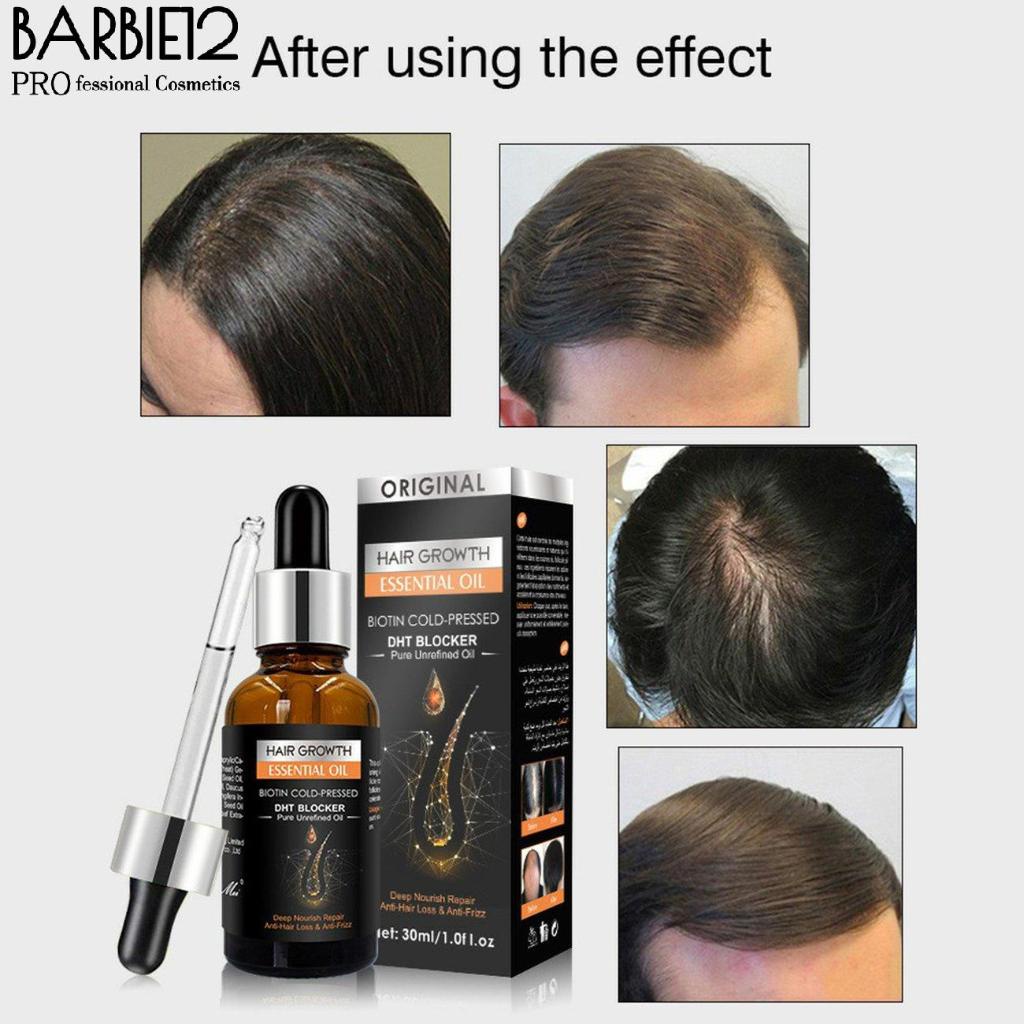 Hair Growth Essential Oil Biotin Cold-Pressed DHT Blocker and Hair Growth  serum Anti-Hair Loss Conditioner | Shopee Singapore