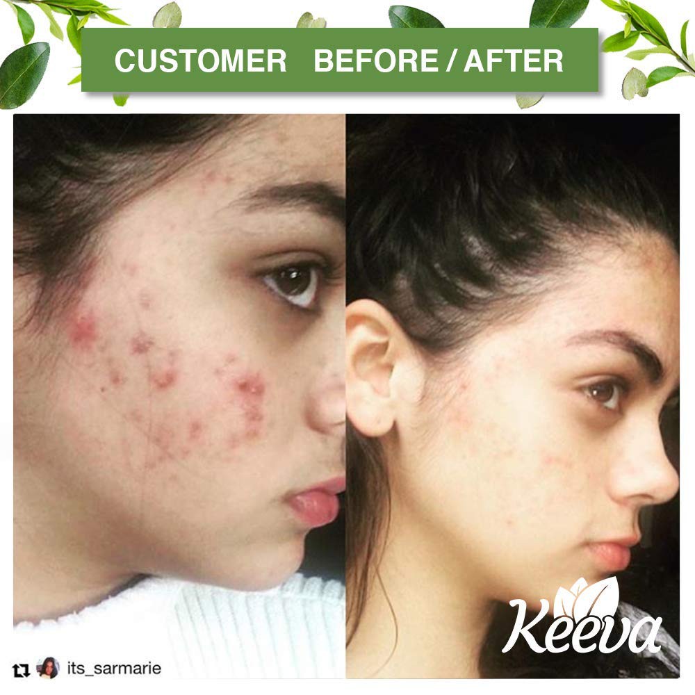 keeva acne scar cream