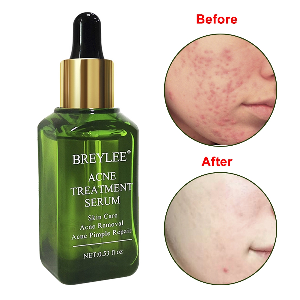 mild acne treatment