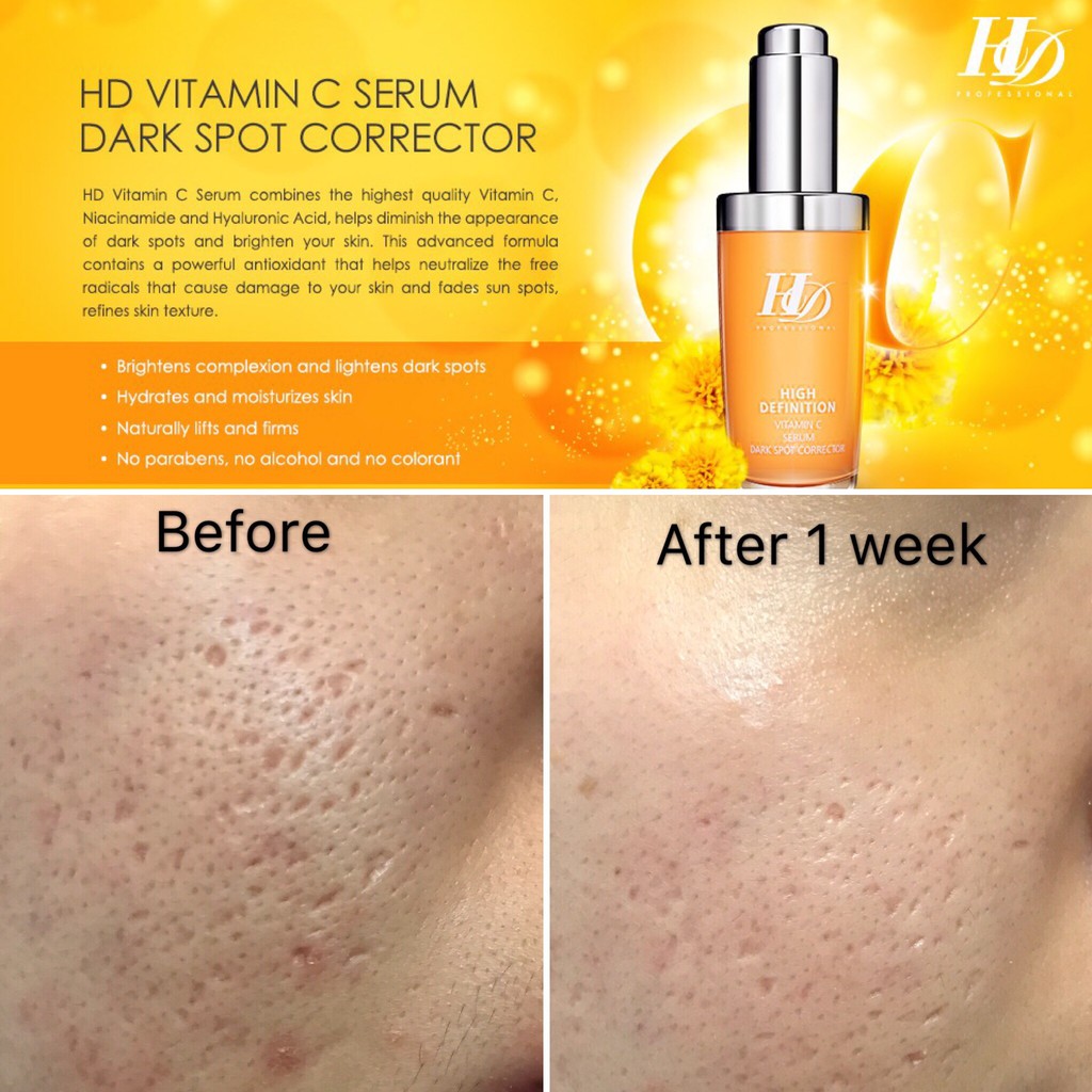 vitamin c for sun spots