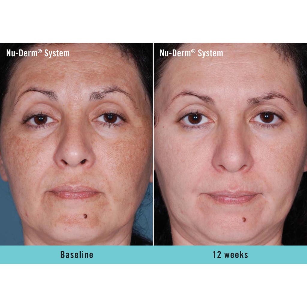 obagi nu derm week 4