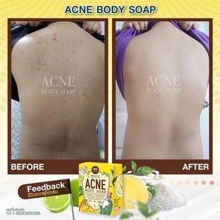 ACNE BODY CLEAR SOAP-made in thailand-70g
