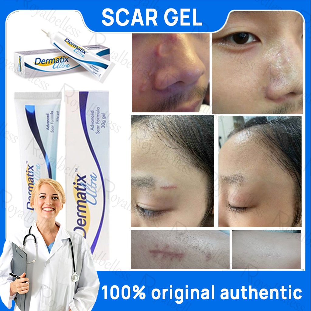 Dermatix Effective Scar Removal Cream Scar Gel Old Scar Acne Scar ...