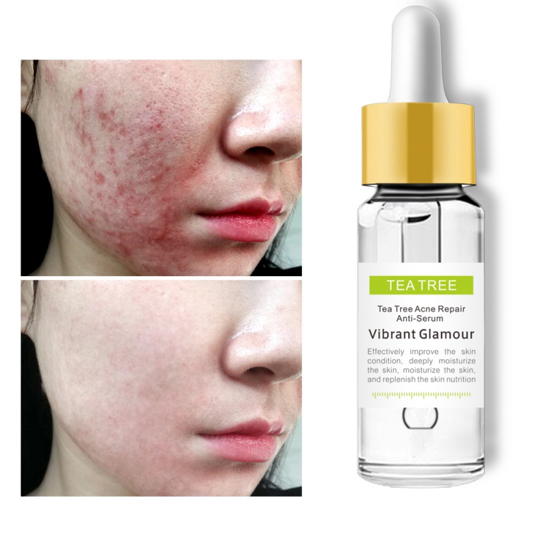 natural serums for acne