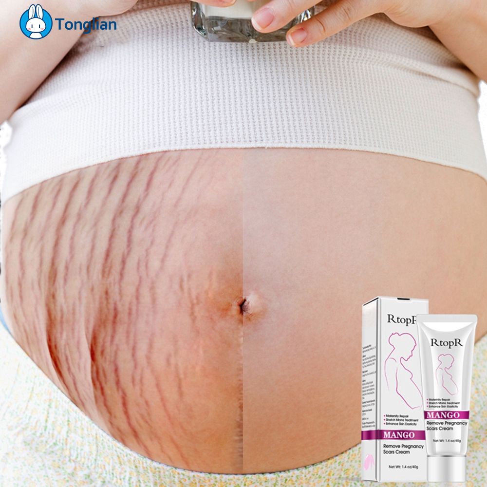 stomach stretch marks cream