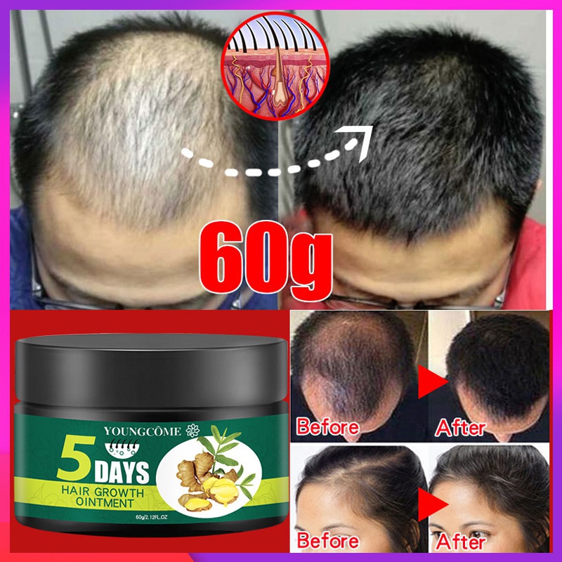 YOUNGCOME Newest Hair Growth Hair Care Ointment Natural Hair Loss Treatment  for Hair Grows Fast Hair Repair Health Care Beauty Dense Hair Growth  Ointment | Shopee Singapore