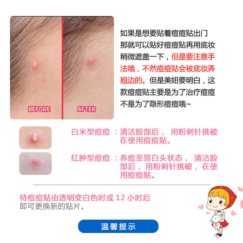 台湾3m人工皮痘痘贴祛痘抗菌伤口大敷料水胶体敷料净痘吸脓 Shopee Singapore