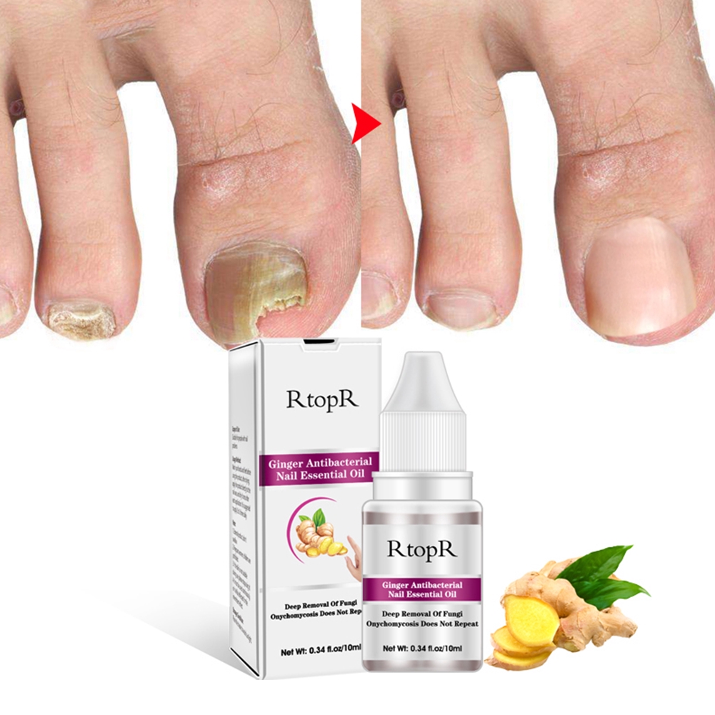 10ml Toe Universal Care Finger Non Infection Anti Fungus Repair Nail Treatment Shopee Singapore