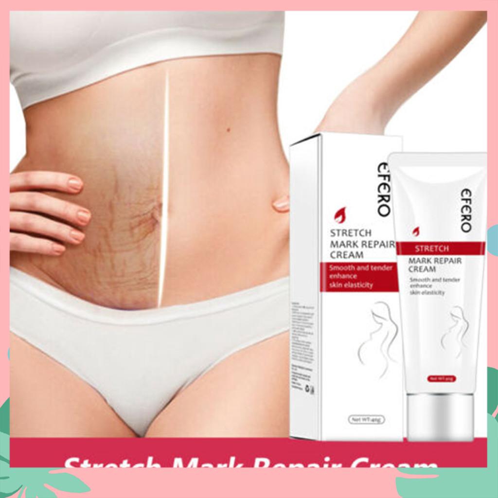 postpartum stretch mark removal