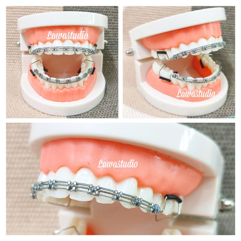 Braces Click Powertrain Design Fashion Braces Clip Click Braces