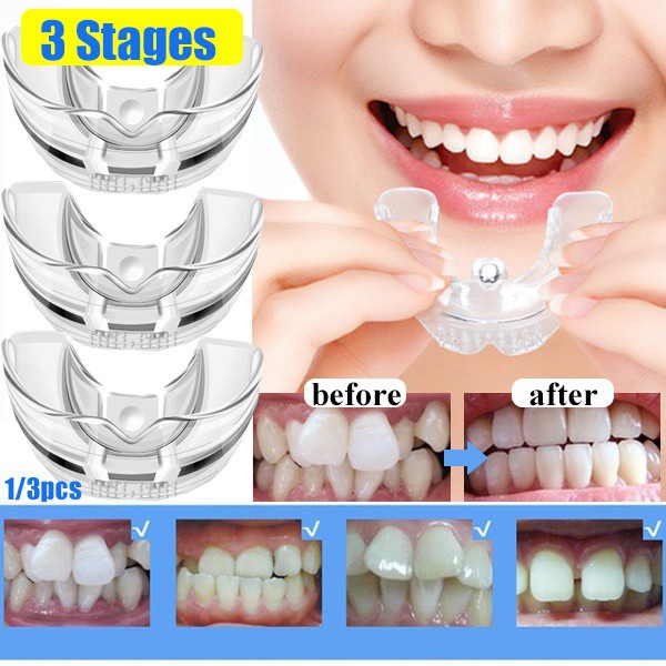 teeth trainer - Prices and Deals - Dec 2022 | Shopee Singapore