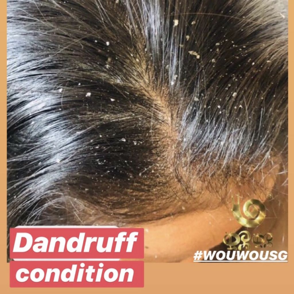 Dandruff Problems Hair Loss Shopee Singapore