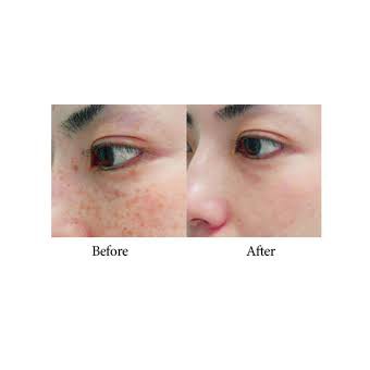 transino medicated whitening essence ex