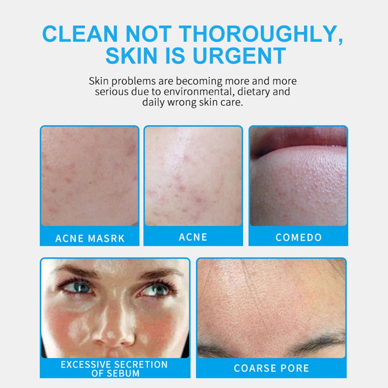 urgent control acne cream