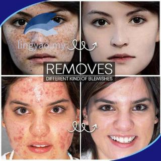 Pro.W Blemish Cream Freckles Acne Pimple Scar Dark Spots ...