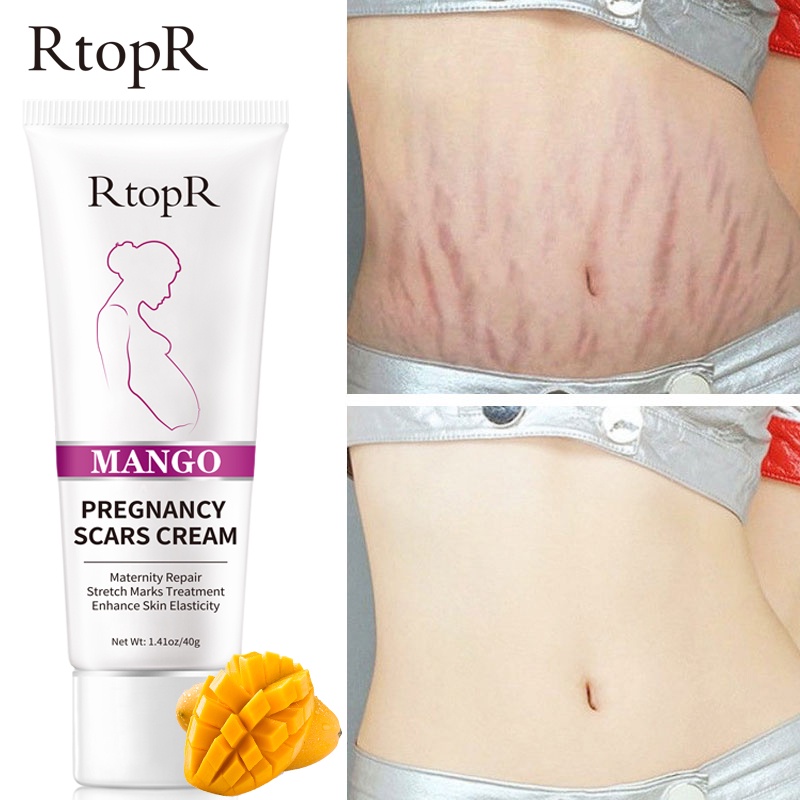RtopR Mango Remove Pregnancy Scars Acne Cream Stretch Marks Treatment Maternity Repair Anti-Aging Anti-Winkles Firming Body Creams