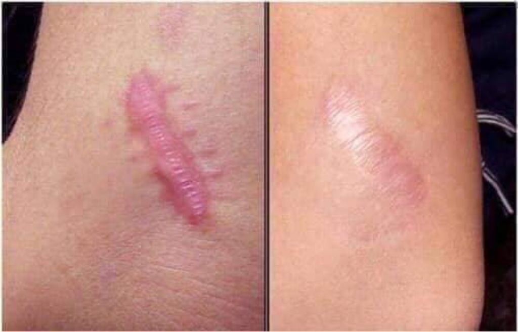 scar pigmentation cream