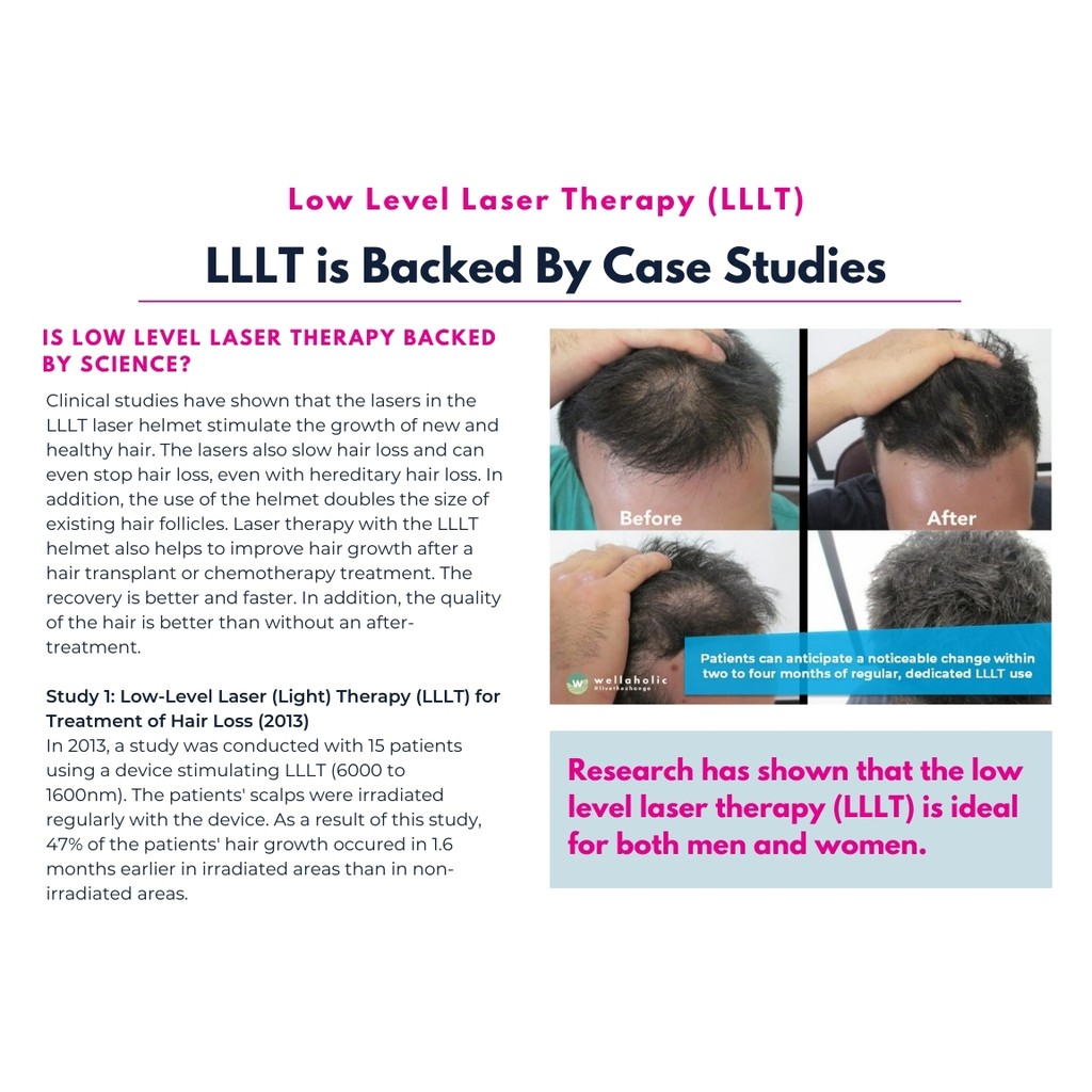 Low Level Laser Therapy for Hair Regrowth (3 sessions) | Shopee Singapore