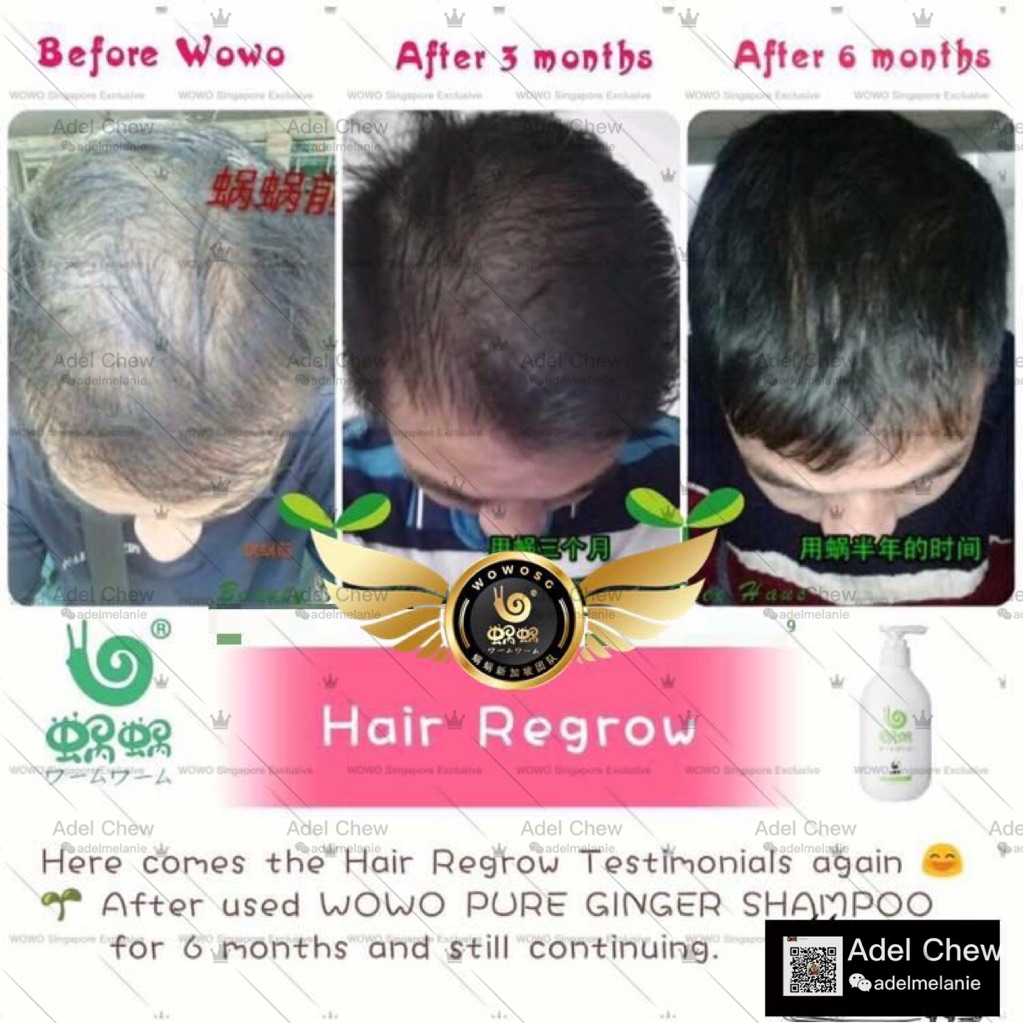 Wowo Shampoo Anti Hair Loss Dandruff Sg Authorized Distributor