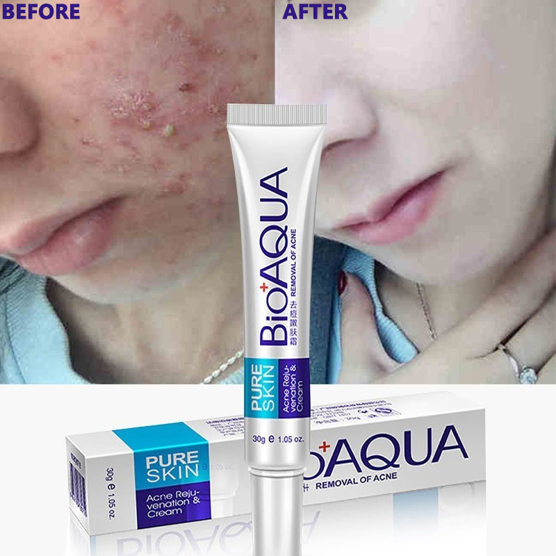 acne marks cream
