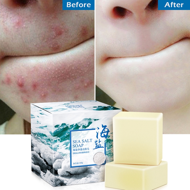 young solution soap for pimples