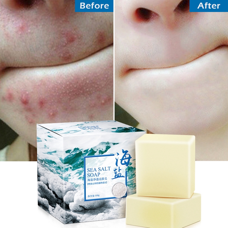 soap-that-can-remove-pimples-best-gambit